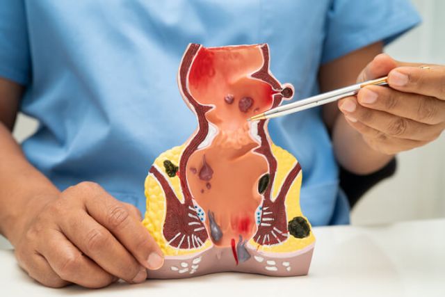 asian-doctor-with-rectum-and-hemorrhoid-human-anat-2025-03-13-19-47-39-utc (1) (1)
